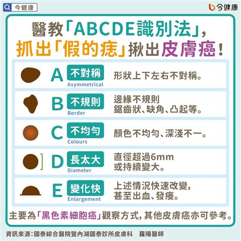 為什麼會長痣|是痣？皮膚癌？還是什麼？常見Q&A解惑！醫教揪出「假的痣」